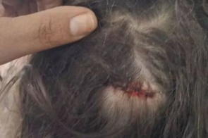 Menina de 7 anos é ferida por bala perdida enquanto dormia em casa