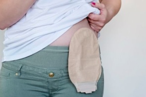 Grupo gratuito oferece apoio a pessoas ostomizadas em Dourados