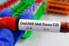 Entenda Doença de Creutzfeldt-Jakob e busca por tratamento