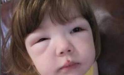 Entre os sintomas apresentados em crianças está o inchaço na região dos olhos (Foto: Reprodução)